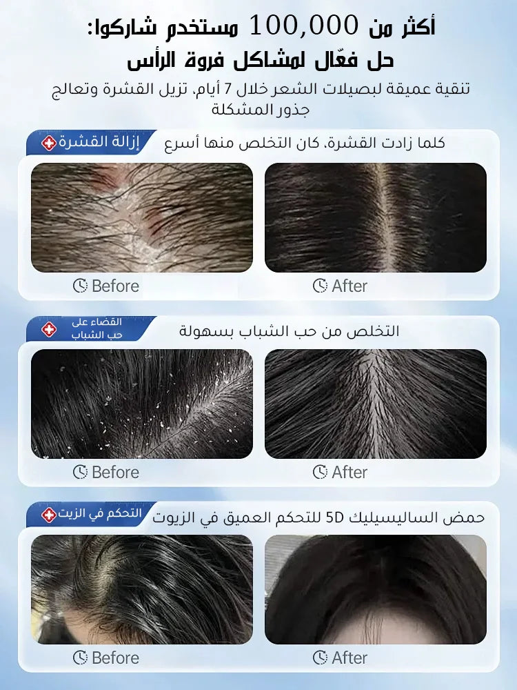 【التخلص من سعفة فروة الرأس العنيدة في 3 أسابيع】شامبو طبي مضاد للبكتيريا والعث